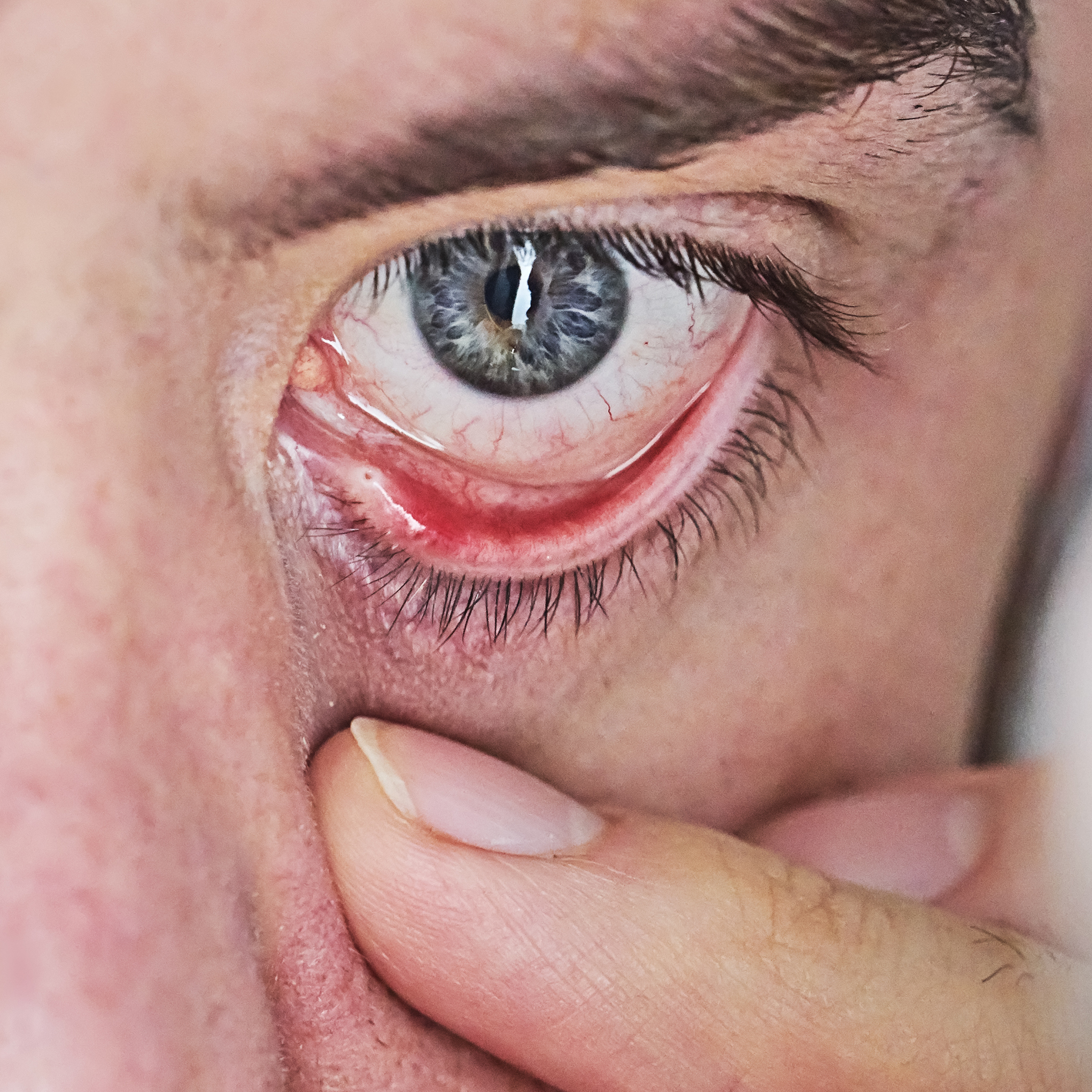 Oeil irrité, gouttes oculaires solution ophtalmique Dacryum